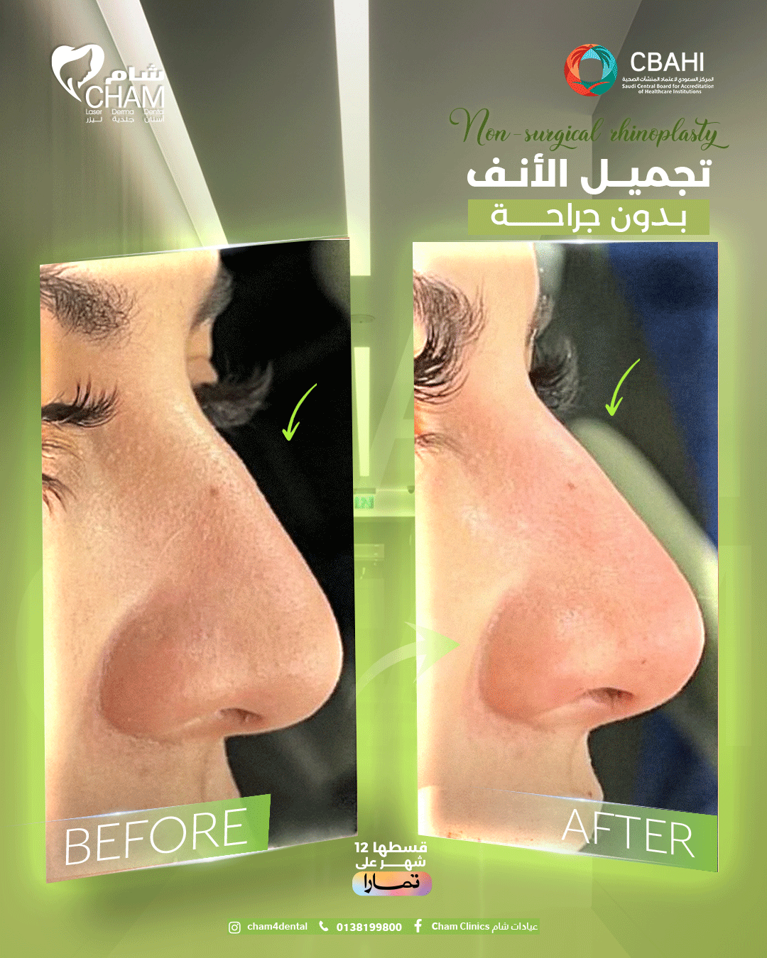 تجميل-الانف